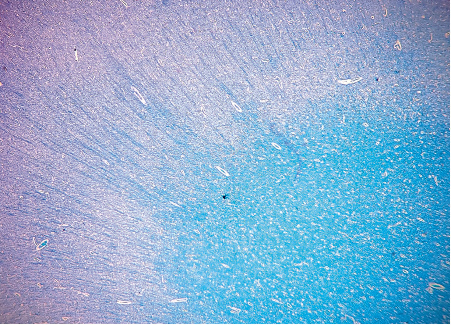 Special Stain Luxol Fast Blue acc. KluwerBarrera Diapath